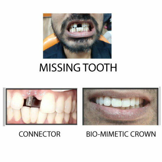 Missing tooth